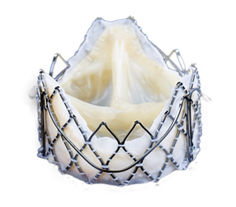 介入人工生物心臟瓣膜-1