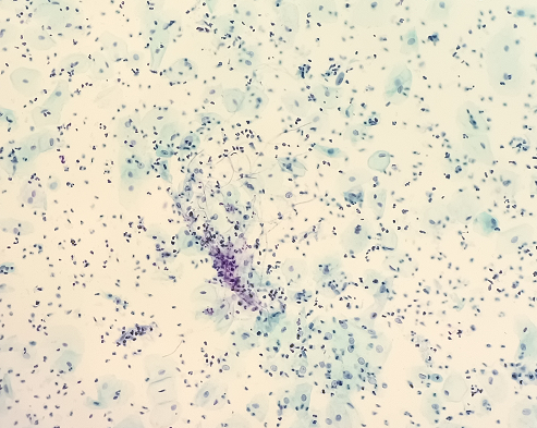 圖3 炎性反應(yīng)性改變細(xì)胞（霉菌感染）