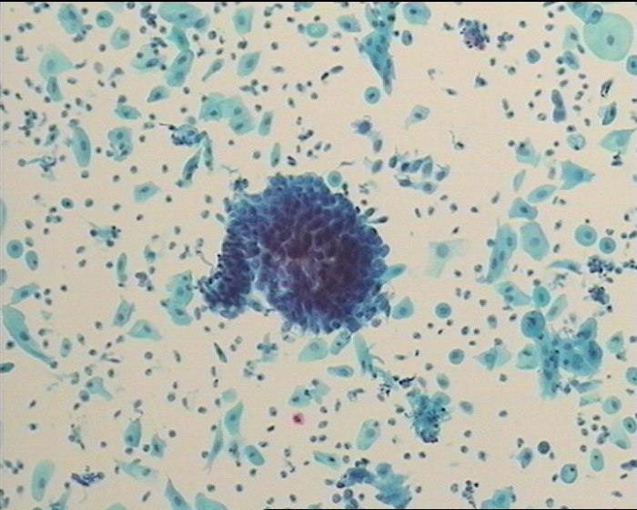 圖8 非典型腺細(xì)胞（AGC）